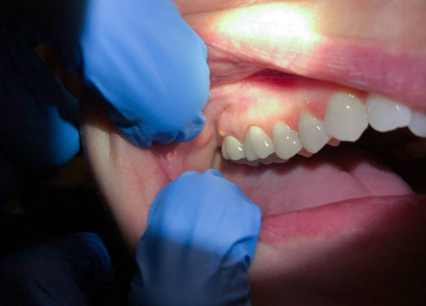 Best Emergency Dental Care for Abscessed Tooth in Fannett, TX
